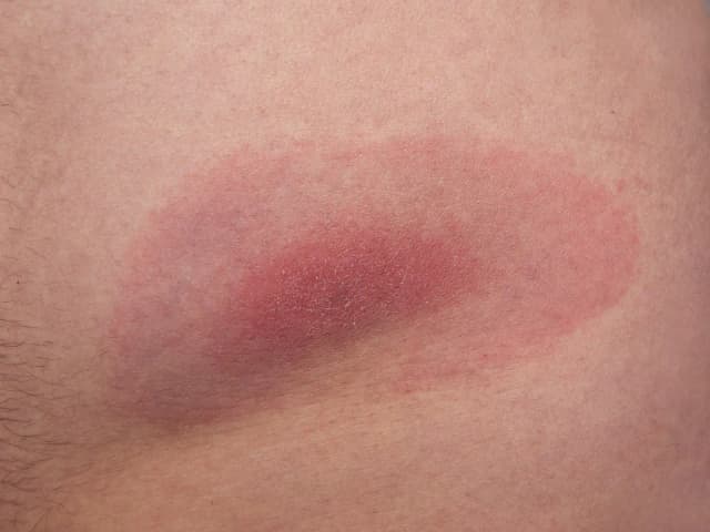 Jak wygląda rumień po kleszczu? Objawy, zdjęcia i ważne informacje Jak wygląda rumień po kleszczu? Objawy, zdjęcia i ważne informacje