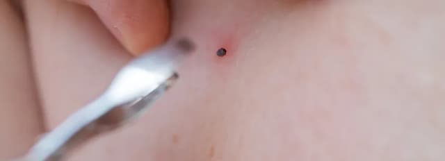 Czym smarować ugryzienie kleszcza? Unikaj tych niebezpiecznych substancji Czym smarować ugryzienie kleszcza? Unikaj tych niebezpiecznych substancji